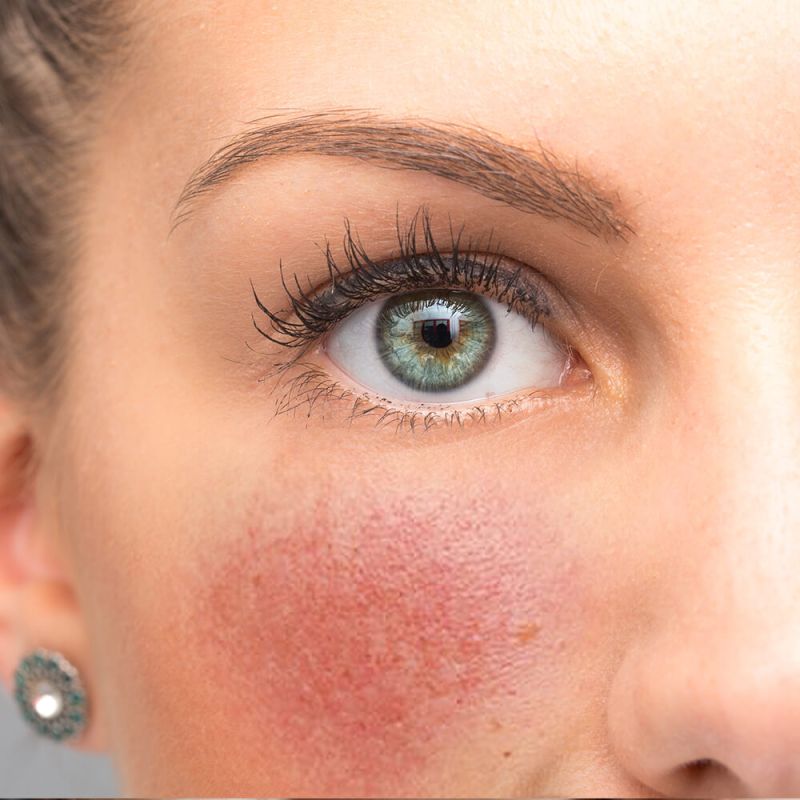 Rosacea & Redness on womans face