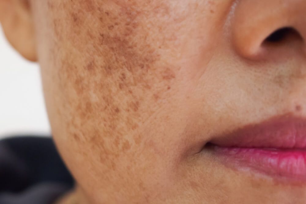 Woman's face with Sun Spots & Freckles