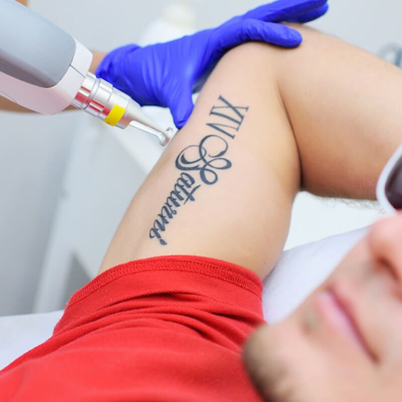 man with unwanted tattoo getting it laser removed