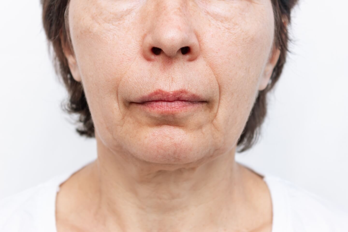 older woman with Sagging Skin & Volume Loss