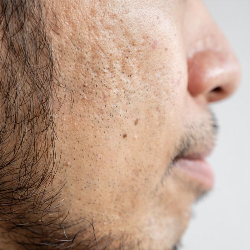 man with acne scars on face
