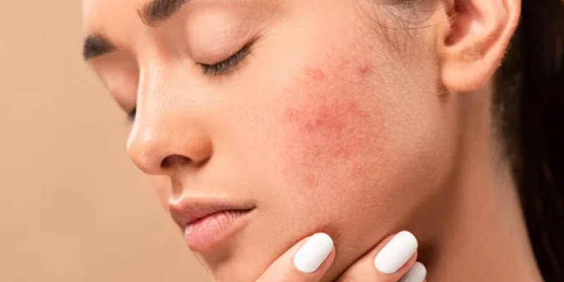Close-up of a young person with acne-prone skin touching their cheek, highlighting skincare concerns.