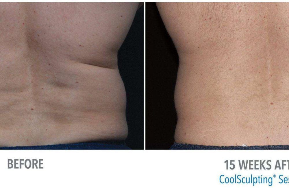 CoolSculpting Side Effects
