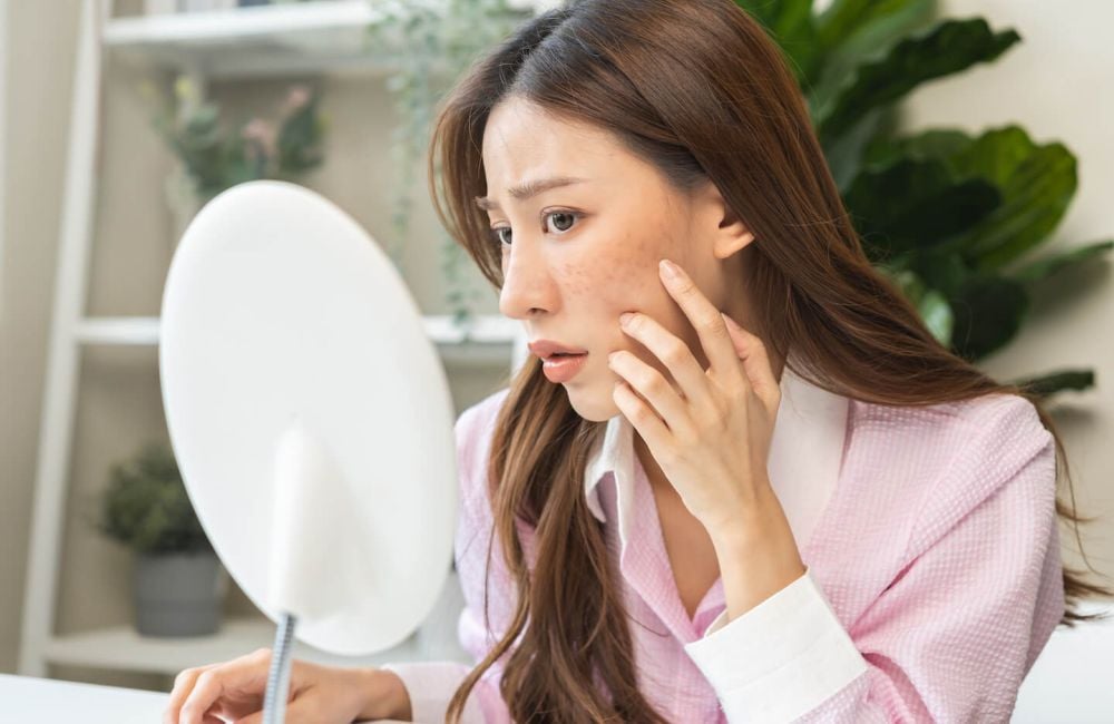 Woman with acne looking into mirror considering BLU-U treatment