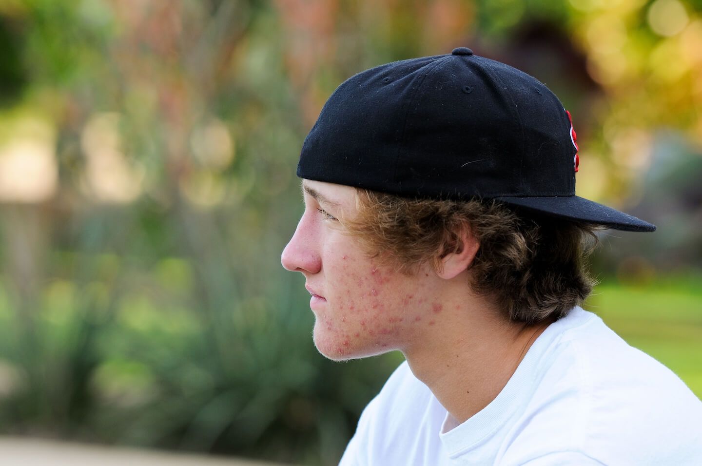 younger male with bad face acne