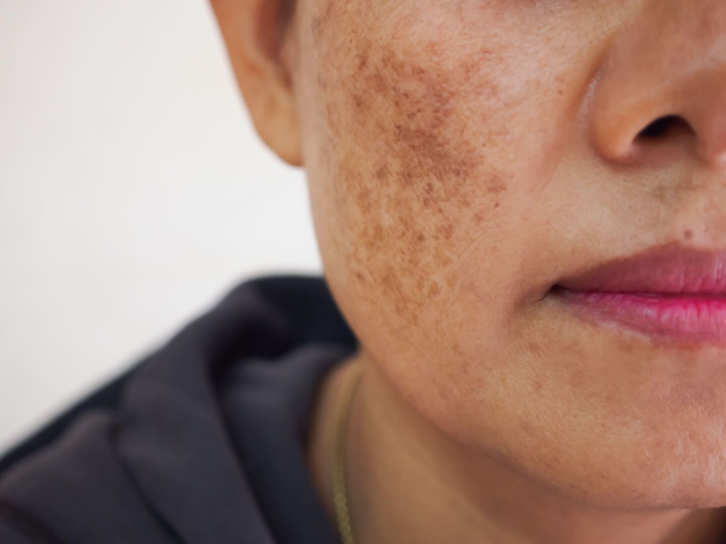 close up of a woman's face with sunspots and freckles