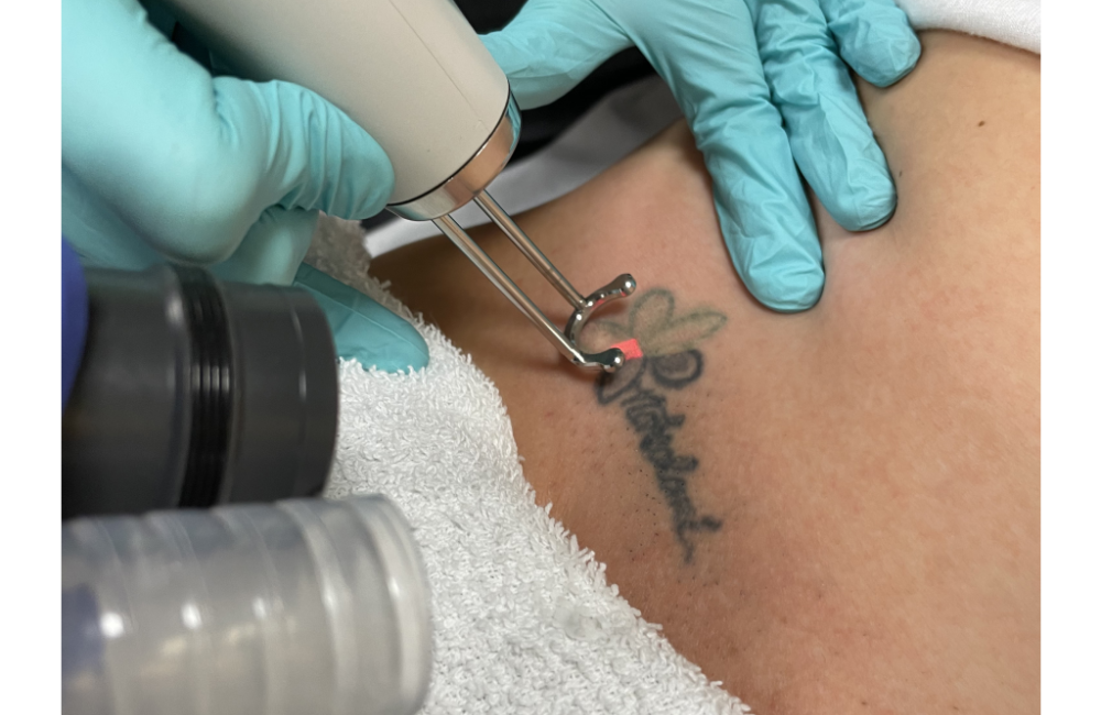 Why Now Is The Time To Get Laser Tattoo Removal