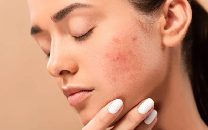 Close-up of a young person with acne-prone skin touching their cheek, highlighting skincare concerns.