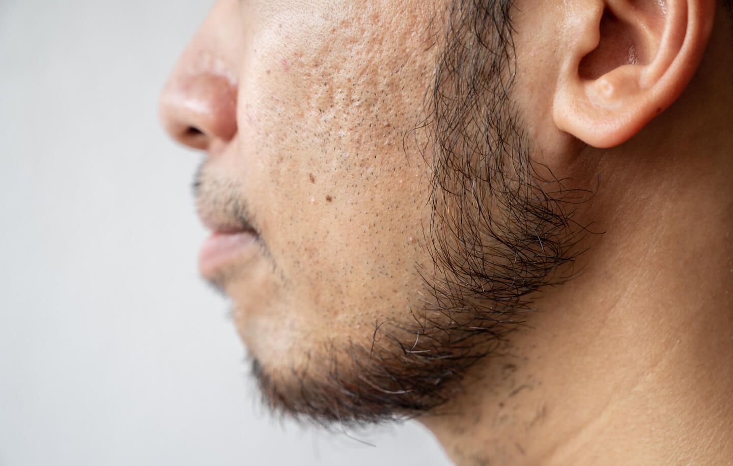 Side view of Asian man face with beard and acne scars