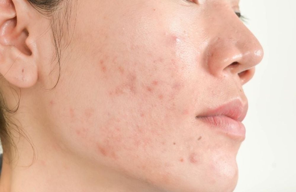 Will Microdermabrasion Help With Acne Scars?