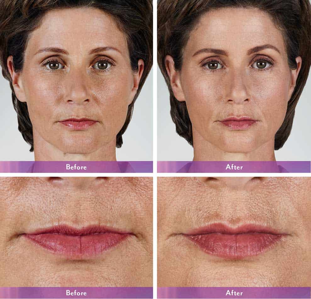 lip filler treatment before and after photos