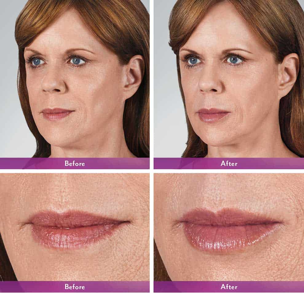 results of lip filler