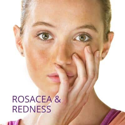 Rosacea Redness