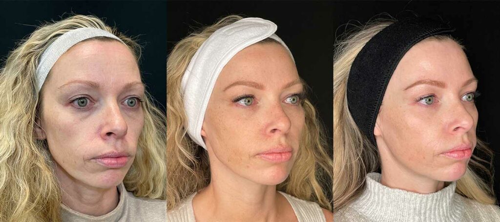 before and after facial care treatment of Christy Keane Can