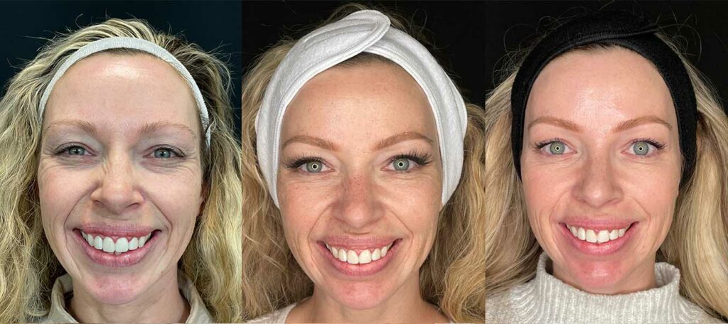 Christy Keane Can before and after pictures of facial care