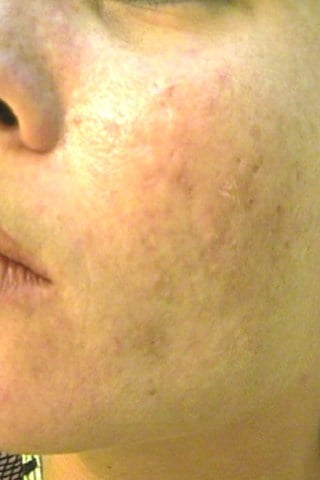 face with bad acne