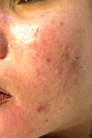 Acne Active Before
