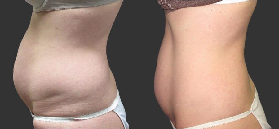 Exilis Ultra before and after female