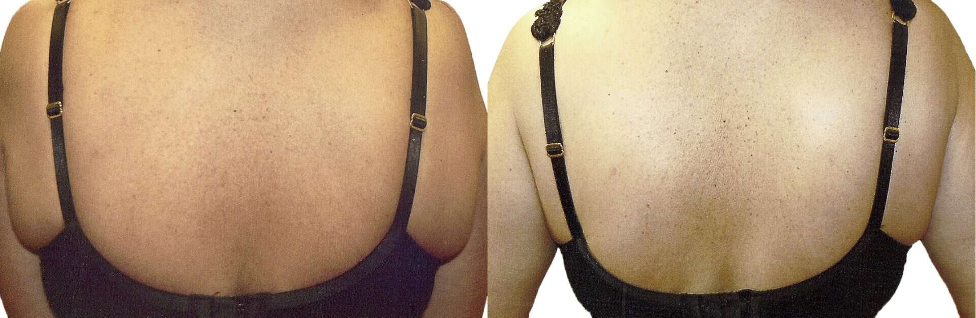 Exilis Ultra before and after back