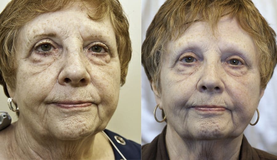 Exilis Ultra before and after face