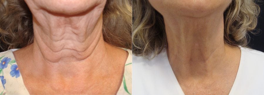 Exilis Ultra before and after neck area