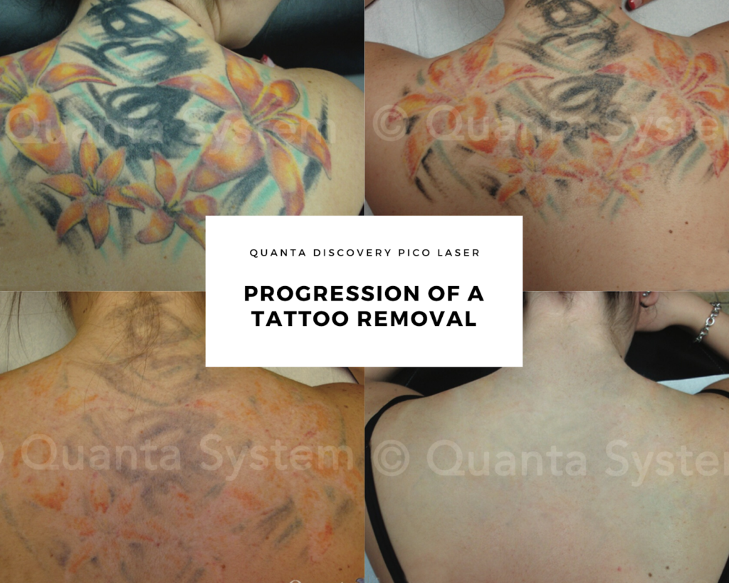 Laser Tattoo Removal in Chesapeake