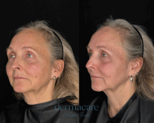 Profile of woman before and after skincare treatment, showing improved skin texture and tone.