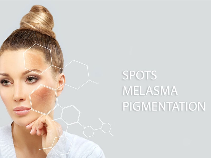 Woman with melasma pigmentation on her face