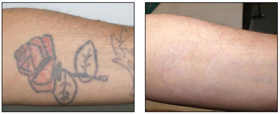 tattoo removal examples