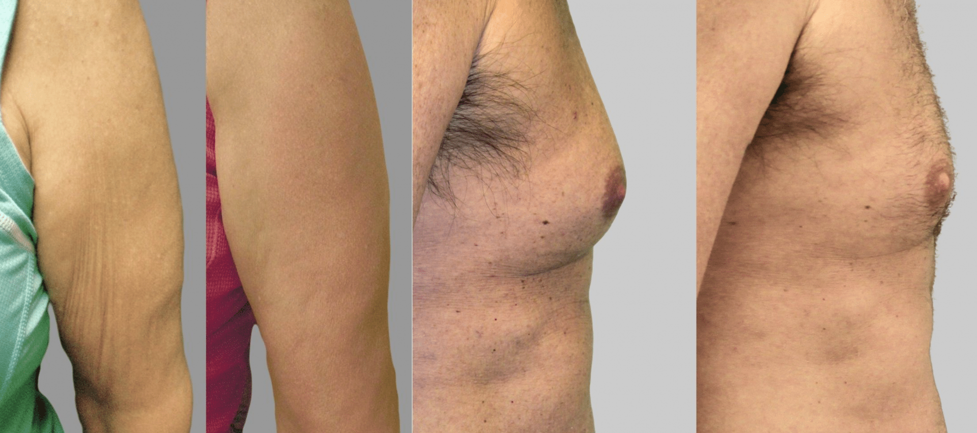 Exilis Ultra before and after photo
