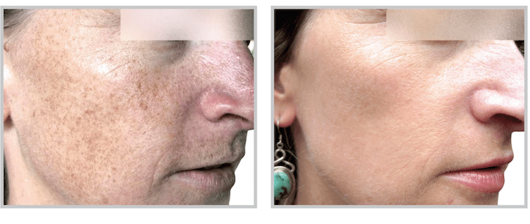 results from FotoFacial BBL