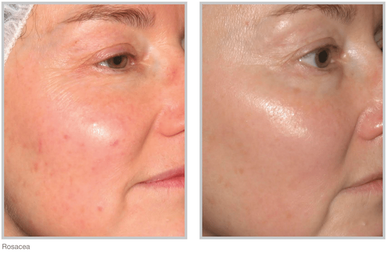 FotoFacial BBL before and after