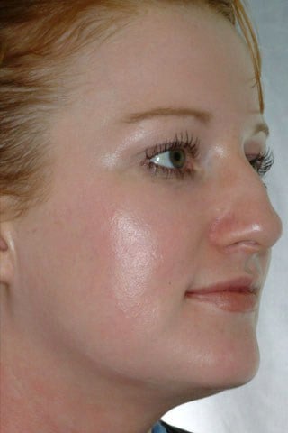Face with sun damage after treatment