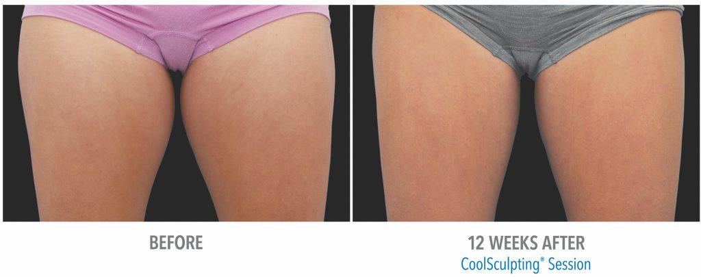 coolsculpting before after