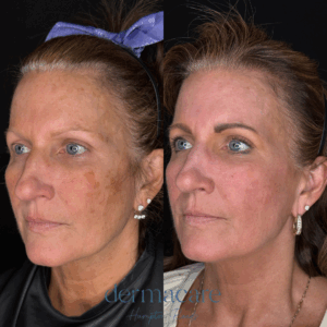 Before and after facial treatment showing improved skin texture and reduced pigmentation on a woman's face.