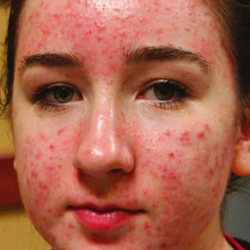 young woman with bad acne on face