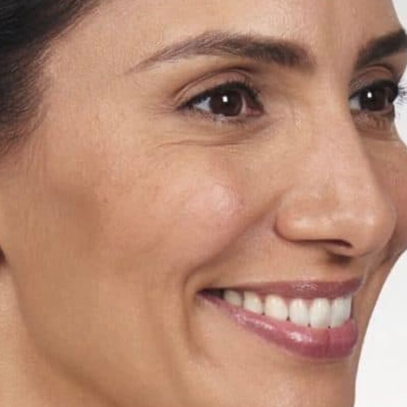 womans face after botox treatment
