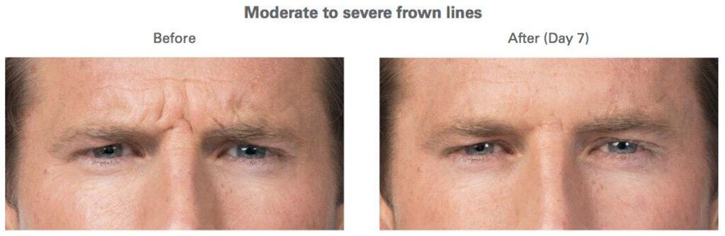 BOTOX® Results Frown lines