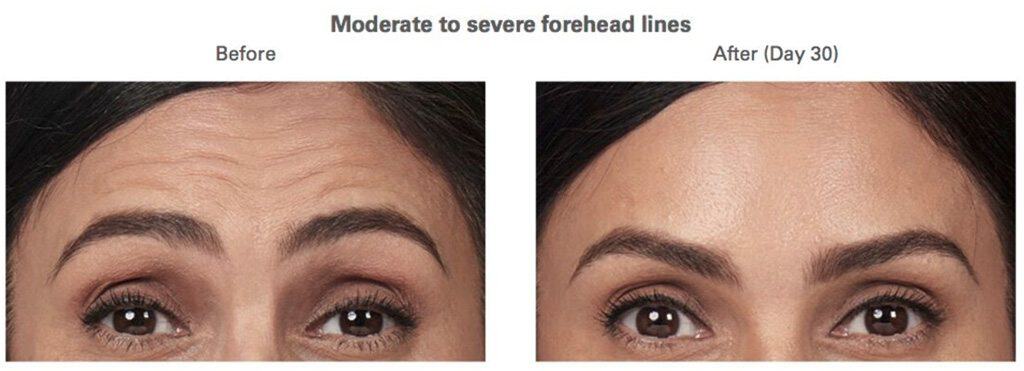 BOTOX® Results forehead lines